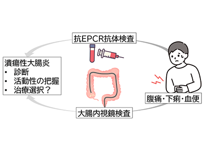 抗EPCR抗体検査が、潰瘍性大腸炎の診断に有用と判明－東北大ほか