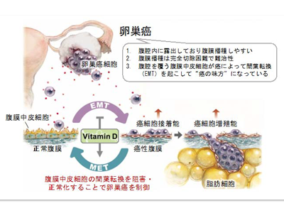 卵巣がん、ビタミンDによる腹膜環境の正常化が新規治療法となる可能性－名大