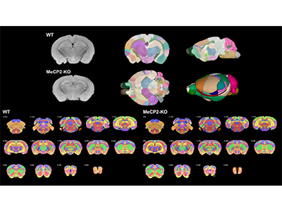 指定難病レット症候群、モデルマウスで脳構造異常を新たに特定－名大ほか