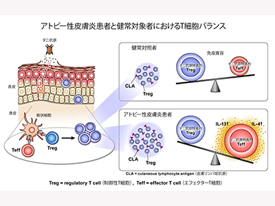 アトピー性皮膚炎、「ダニ特異的エフェクターT細胞＞制御性T細胞」で発症－筑波大ほか