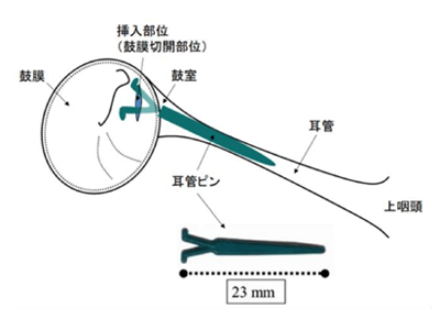 よくわかる耳管開放症 : 診断から耳管ピン手術まで - メルカリ
