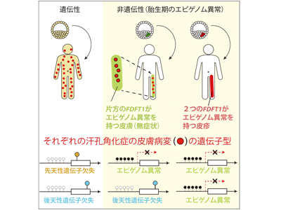 汗孔角化症、FDFT1遺伝子のエピゲノム異常が発症に関わることを発見－神戸大ほか