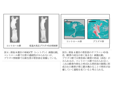 難治性骨折の治癒促進するプラズマ照射法を開発、損傷部強度3.5倍に－大阪公立大