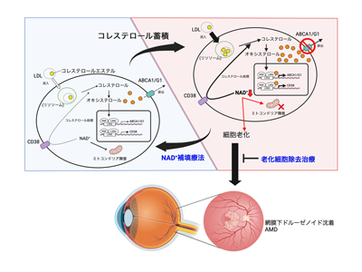 加齢黄斑変性の前駆病変、治療法確立につながる仕組みを明らかに－東大病院ほか