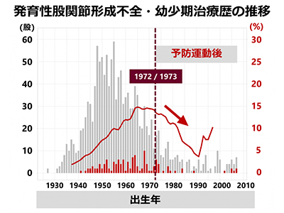 乳児股関節脱臼の予防運動が効果的だったと判明、ライフコース疫学で－九大ほか