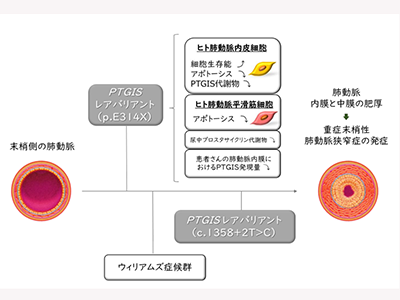 ウィリアムズ症候群合併の末梢性肺動脈狭窄症、増悪関連レアバリアント同定－北大ほか