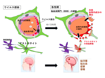 インフルエンザ脳症、大量蓄積のウイルスタンパク質制御で治療できる可能性－阪大