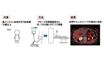 インスリノーマ、新開発のPET／CT検査で高精度検出に成功－京大