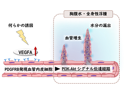 「特発性多中心性キャッスルマン病」の病態形成に関与する遺伝子群を同定－岡山大