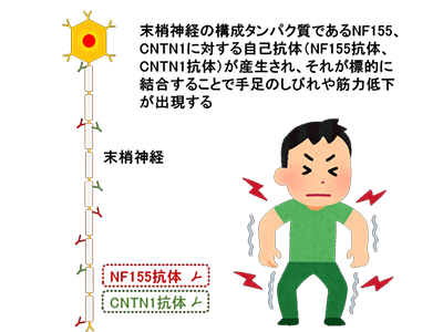 CIDP・自己免疫性ノドパチー診断補助キット承認、NF155/CNTN1抗体測定－九大ほか