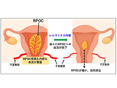 次の妊娠の妨げとなる流産後の遺残組織排出促進に「レルゴリクス」が有効－山梨大