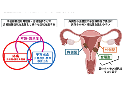子宮腺筋症の黄体ホルモン療法、効果予測にMRI画像による評価が有効と判明－東大
