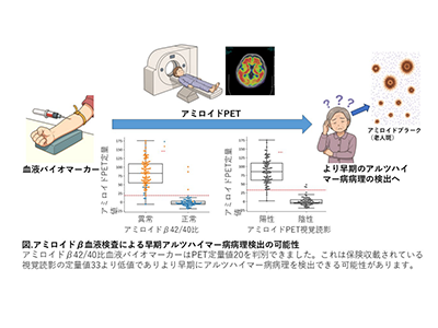 アルツハイマー病、PET検査より高精度な血液バイオマーカーが判明－慶大