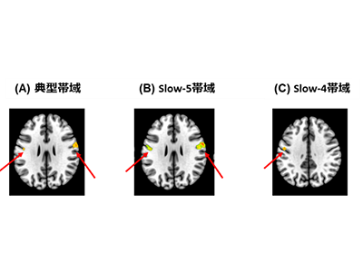 社会不安症患者、身体感覚を処理する脳領域の脳活動が低下していると判明－千葉大